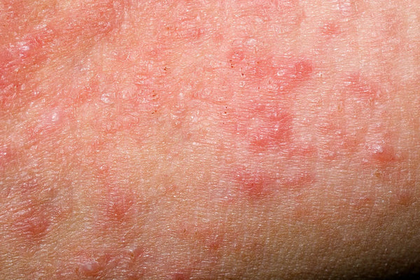 Acne & Redness