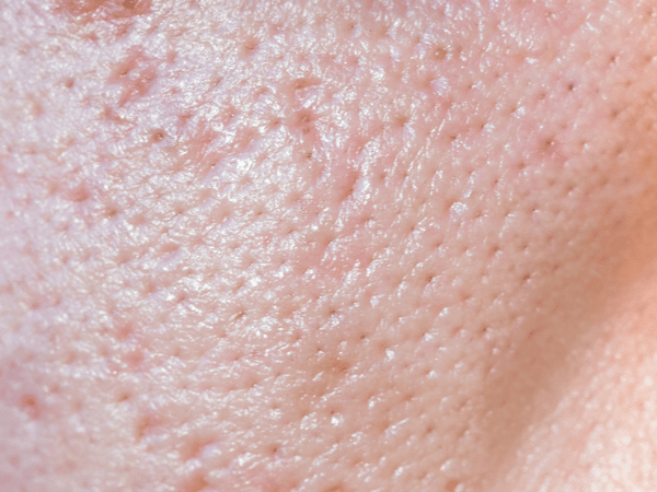 Sagging Pores